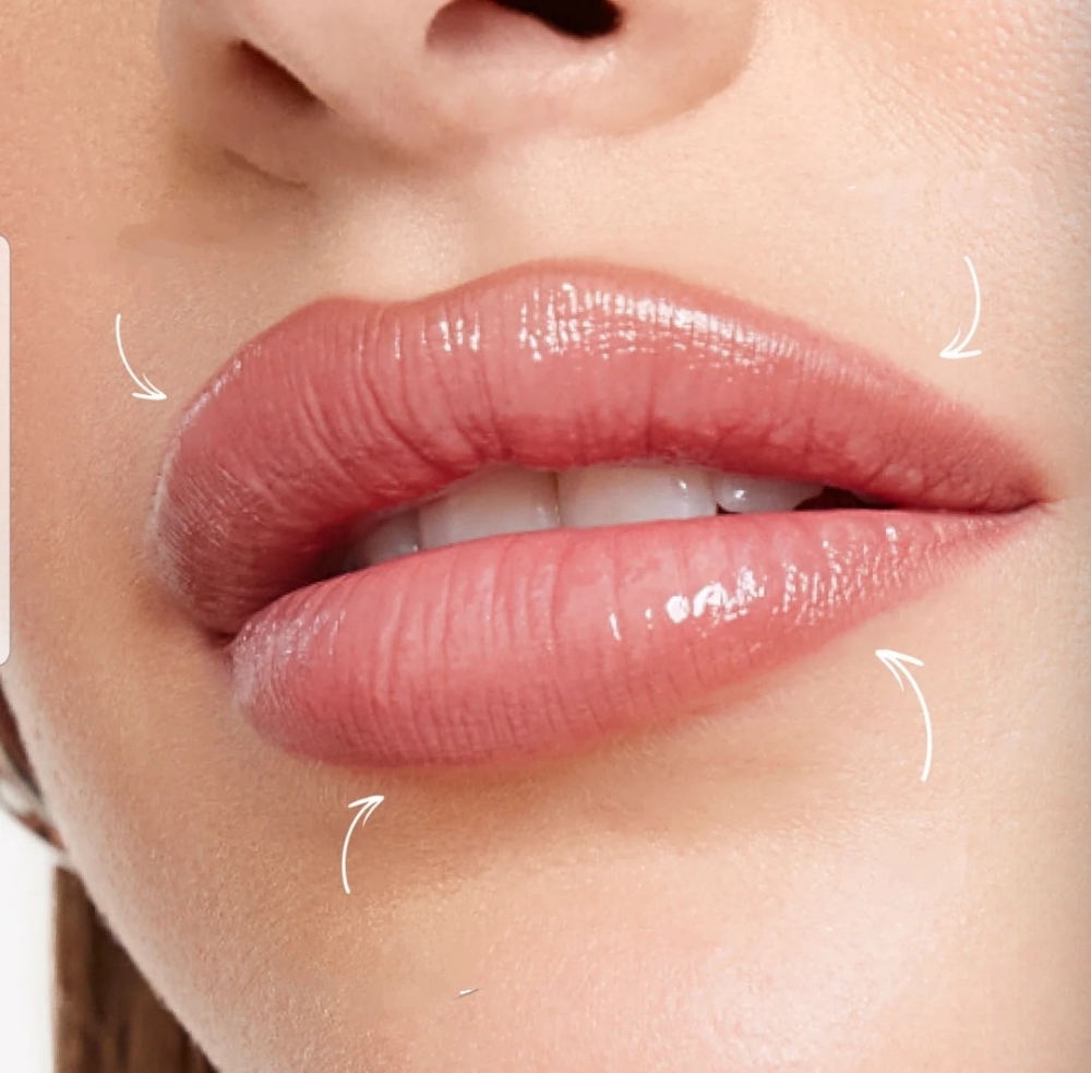 Lip Filler