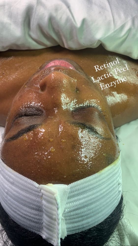Chemical Peel System