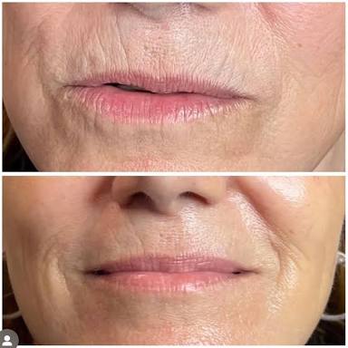 Lip Rejuvenation By Lisa