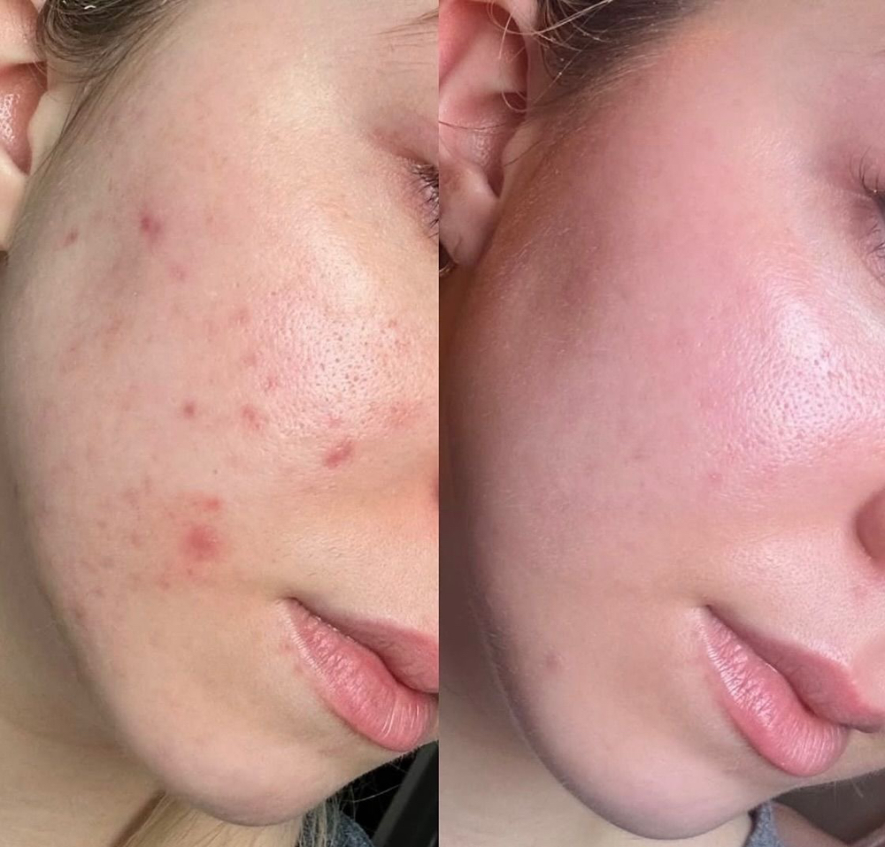 Chemical Peel at FaceTHEbeauty Esthetics in Devine, TX