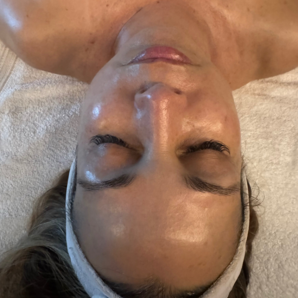 Chemical Peel at Anaiz Beauty in West Palm Beach, FL