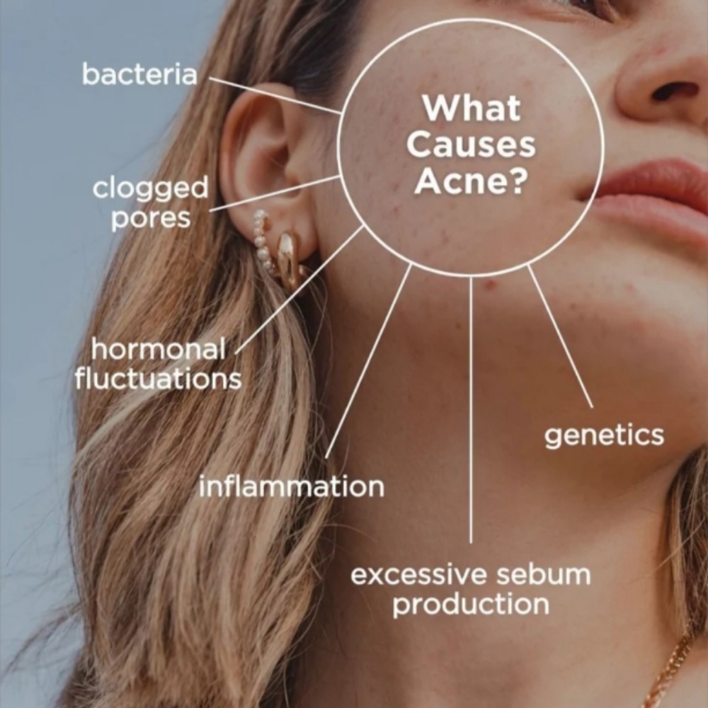 Acne-clearing Facial at Bare or Beat in Fayetteville, NC