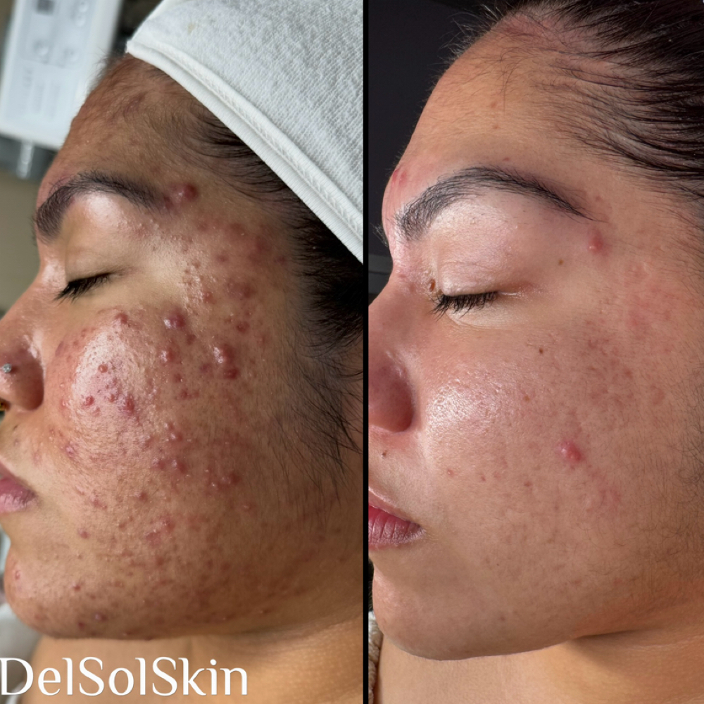 Acne Consulation at Del Sol Skin in East Islip, NY