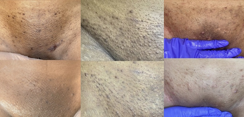 VAJACIAL-III Skin Lightening at Euphoric Skin and Beauty in Hampton, GA