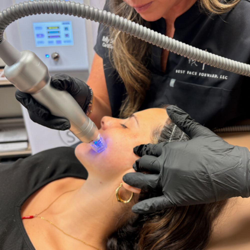 Scarlet RF microneedling at Best Face Forward in Lebanon, TN