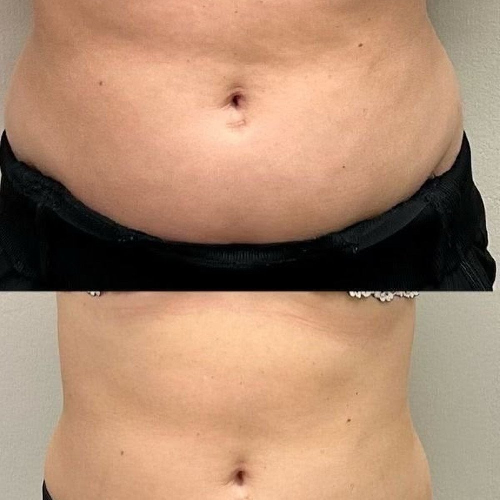 Beach BODY RF Skin Tightening at MlbeautySpa in Boynton Beach, FL