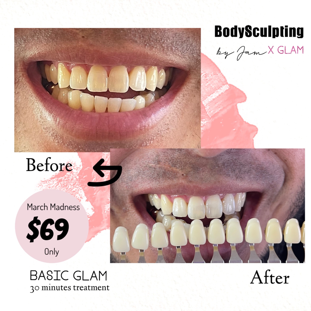 Teeth Whitening 30 Mins
