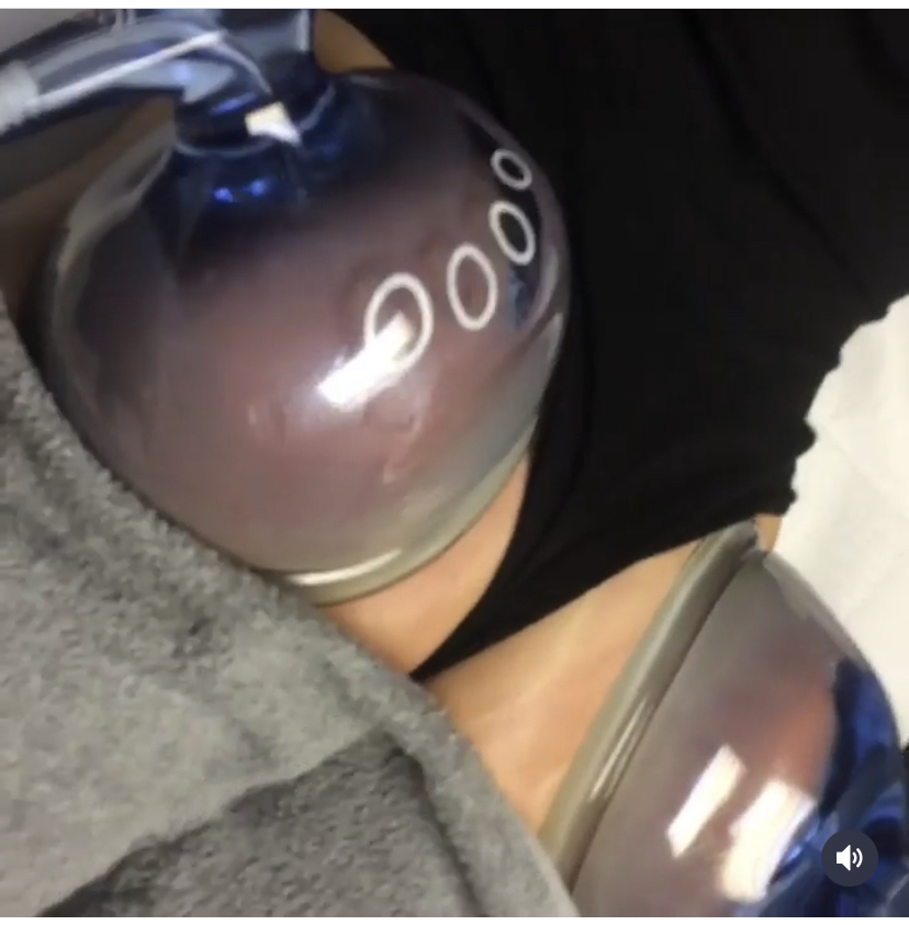 3 Non-Surgical Butt Lift Sessions