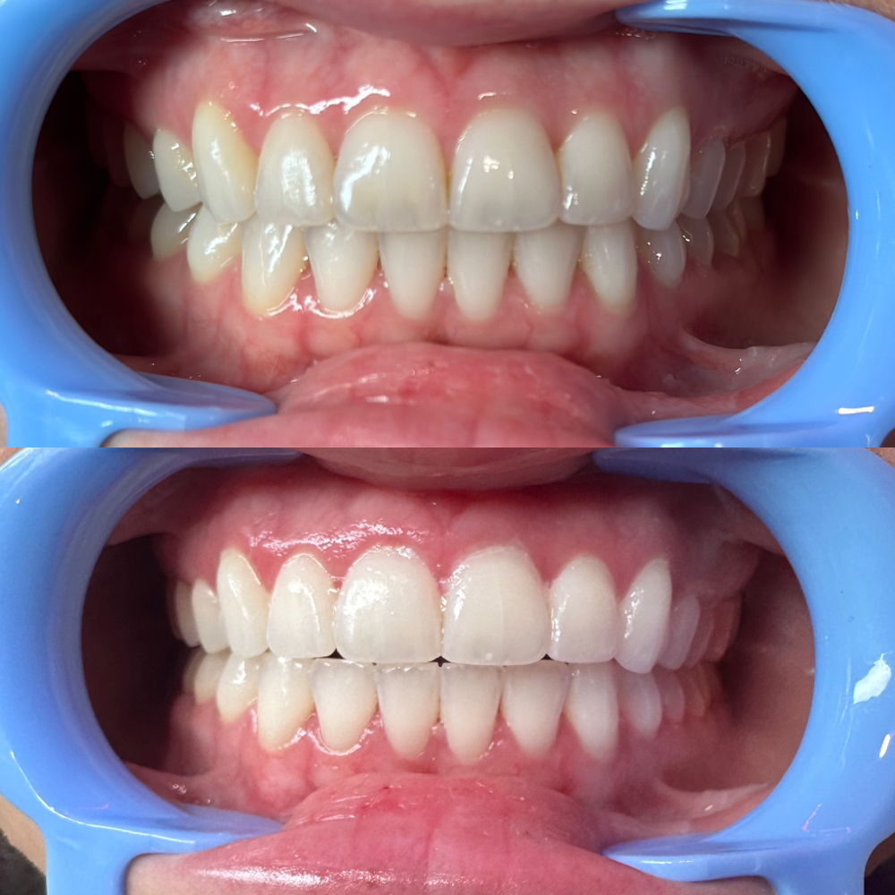 Laser Teeth Whitening (3 Sessions)