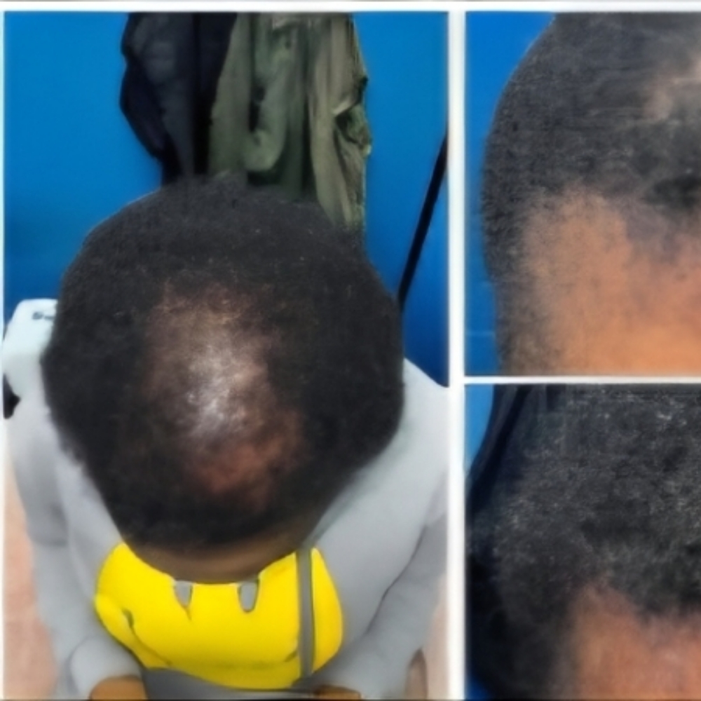 3Hair Regenerative Treatments 3