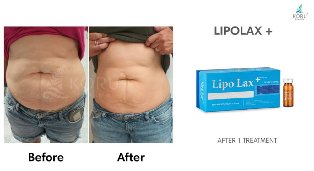 Lipo-Lax Abdomen