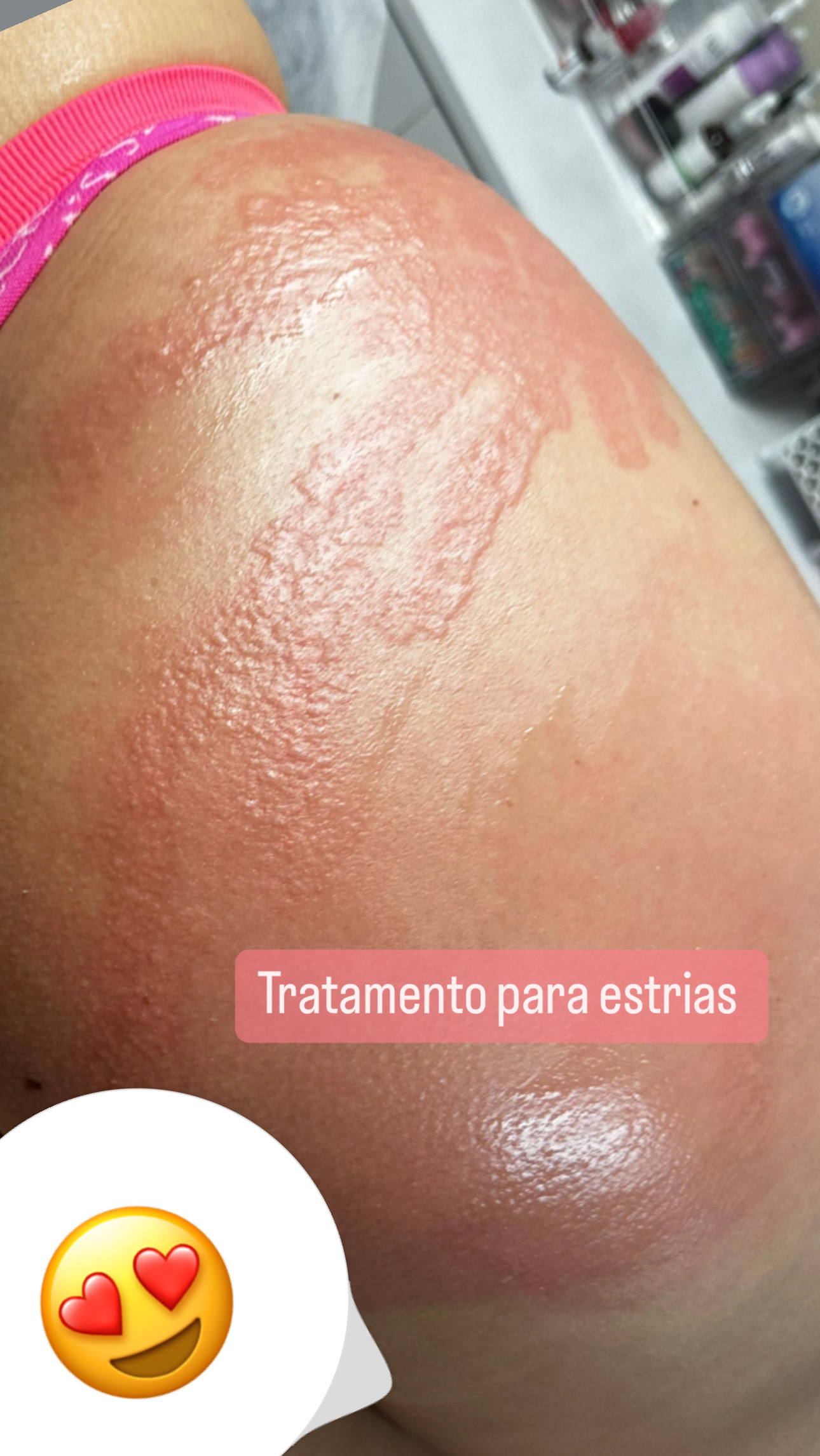 Striort - Stretch Marks Treatment