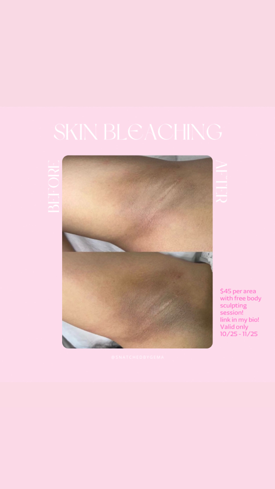 Skin Bleaching