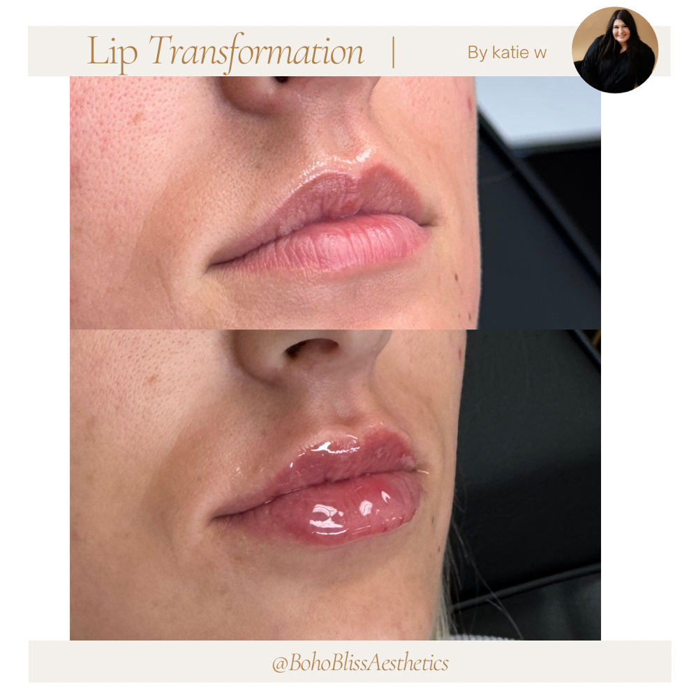 1/2 Lip Filler
