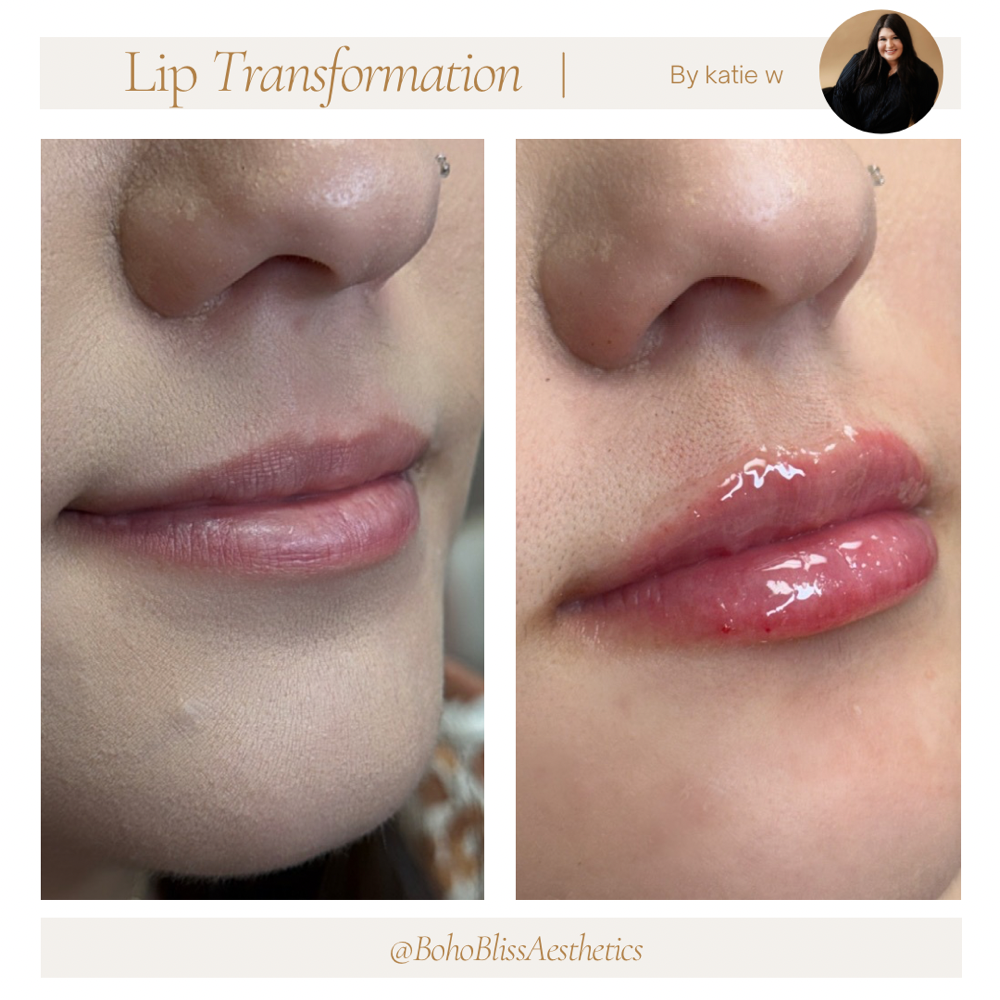 1/2 Lip Filler