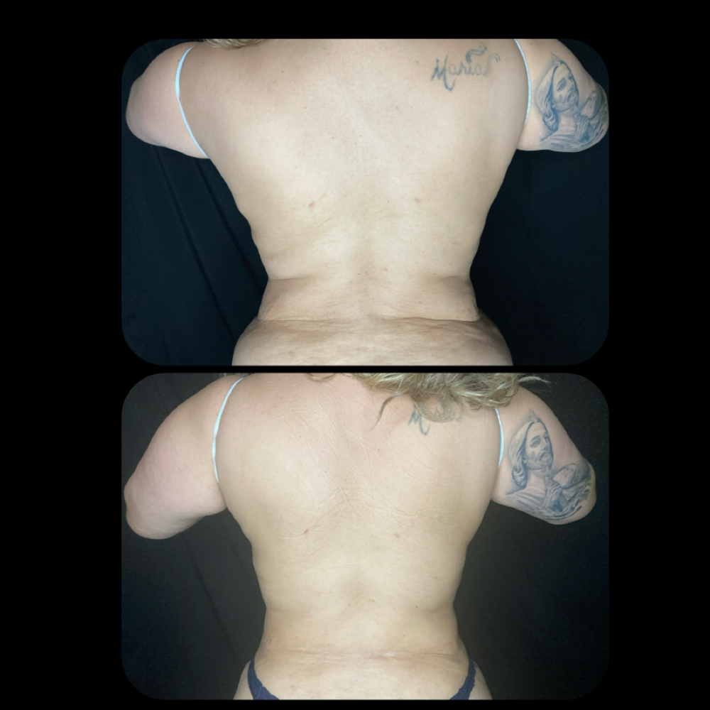 Cavitation Session at Glo’s Beauty Creations