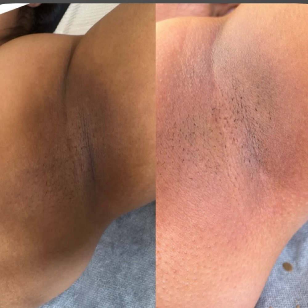 Intimate Bleaching at Pretty Deluxe Day Spa in Syracuse, NY