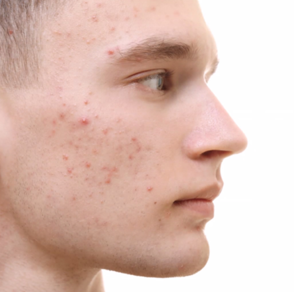 Acne Facial at Skin Pro Institute in Idaho Falls, ID
