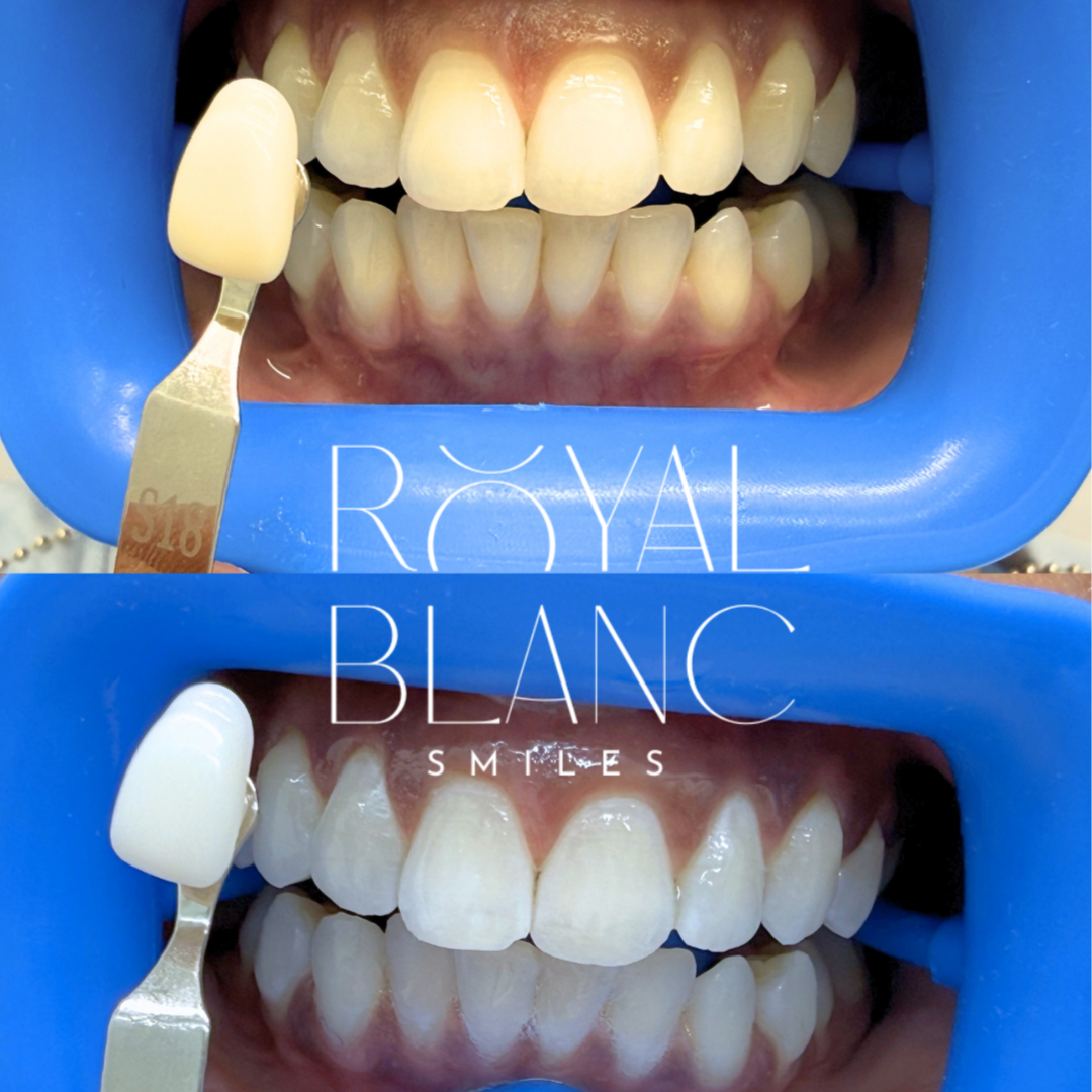 Soft Teeth Whitening at Royal Blanc Smiles - Teeth Whitening and Tooth Gems in Charlotte, NC in Charlotte, NC