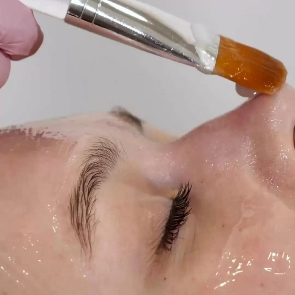 Custom Facial & Acne Peel at A.L aesthetics in Dawsonville, GA