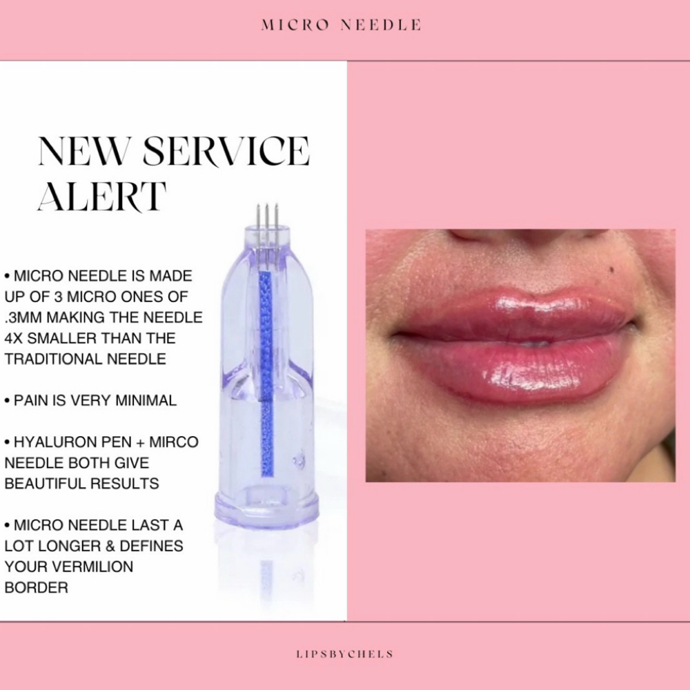 1.5 Micro Needle at LipsByChels in Dallas, TX