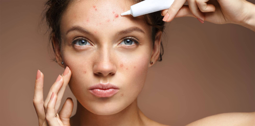 Acne Lift Peel