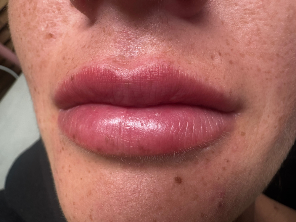 1.5ML LIP ENHANCEMENT at GLOW BY MARTINA in Grass Valley, CA
