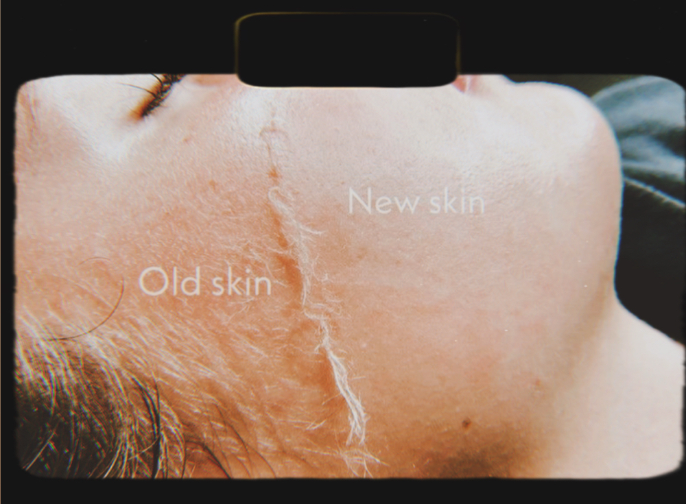 Dermaplaning