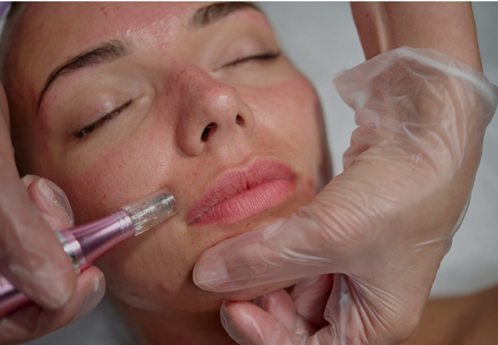 Microneedling at NAIKED ESTHETICS BY NAOMI in TUCSON, AZ
