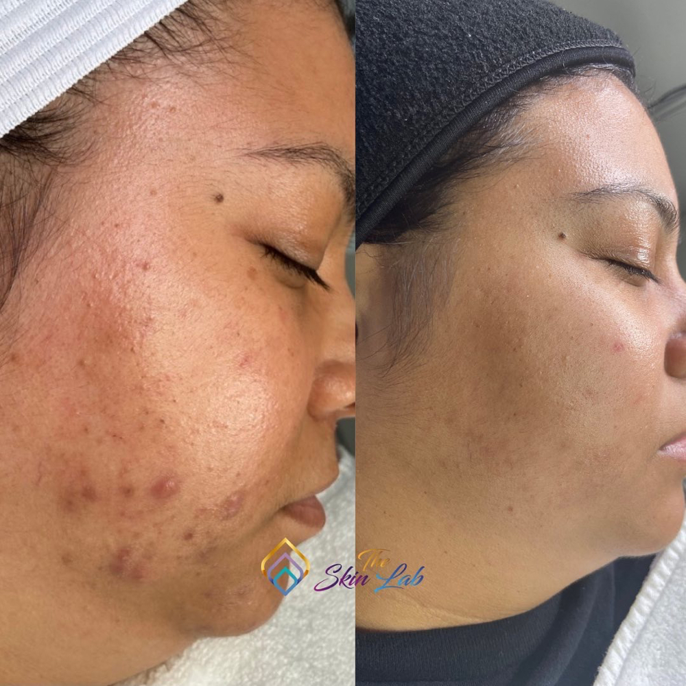 Peel Hyperpigmentation 1