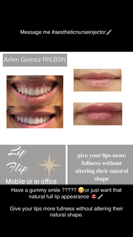 Lip Flip - Top &/or Bottom -Xeomin