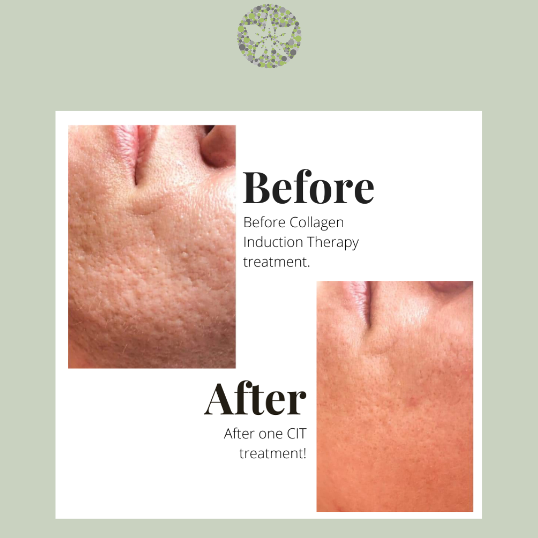 CIT Microneedling