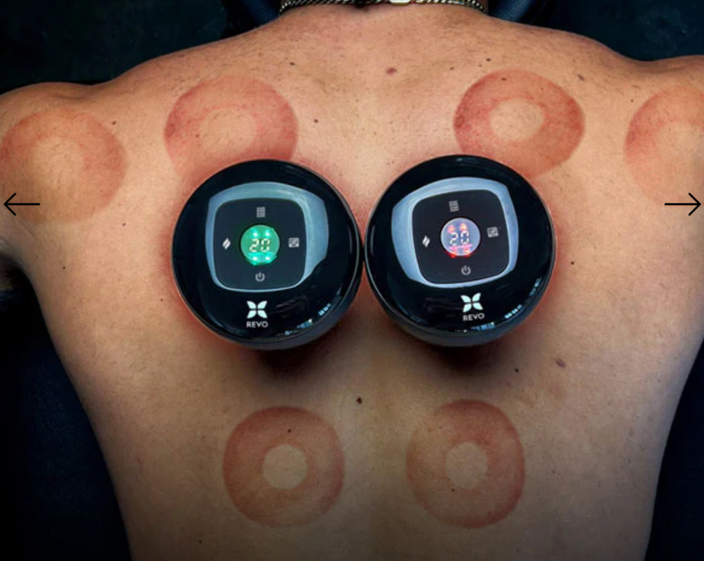 Cupping Therapy at Body Health Massage & Wellness in Seminole, FL