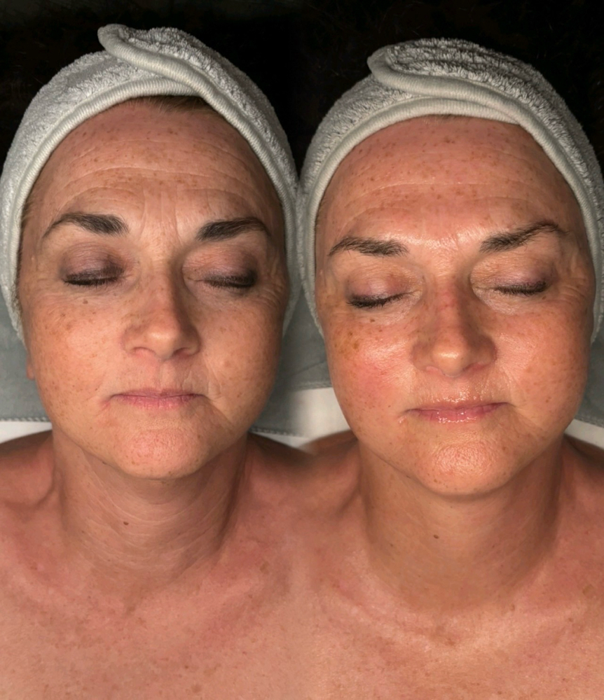Chemical Peel With Firming Mask
