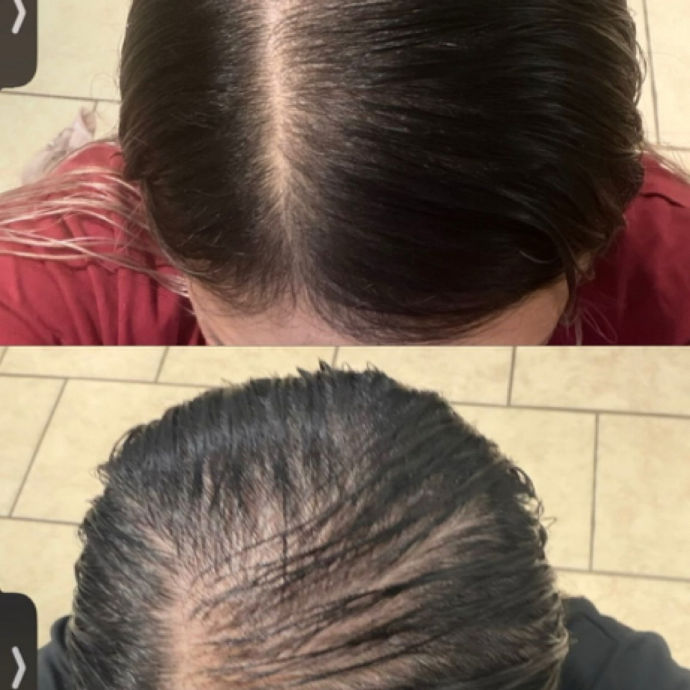 Hair Restoration Therapy at Davis Wellness & Aesthetics in Cleburne, TX
