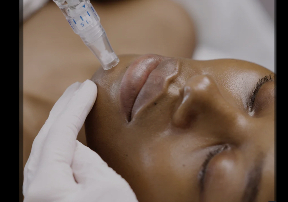 Microneedling Treatment