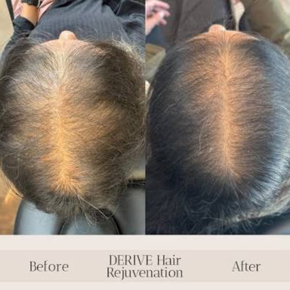 DE|RIVE Hair Rejuvenation at Alora Aesthetics in Hilton Head Island, SC