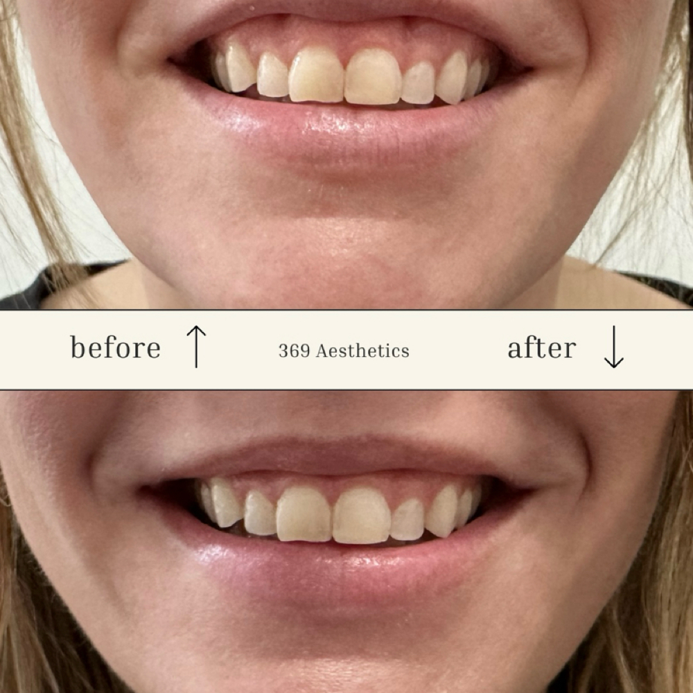 Gummy Smile Fix at 369 Aesthetics in Burlington, IA