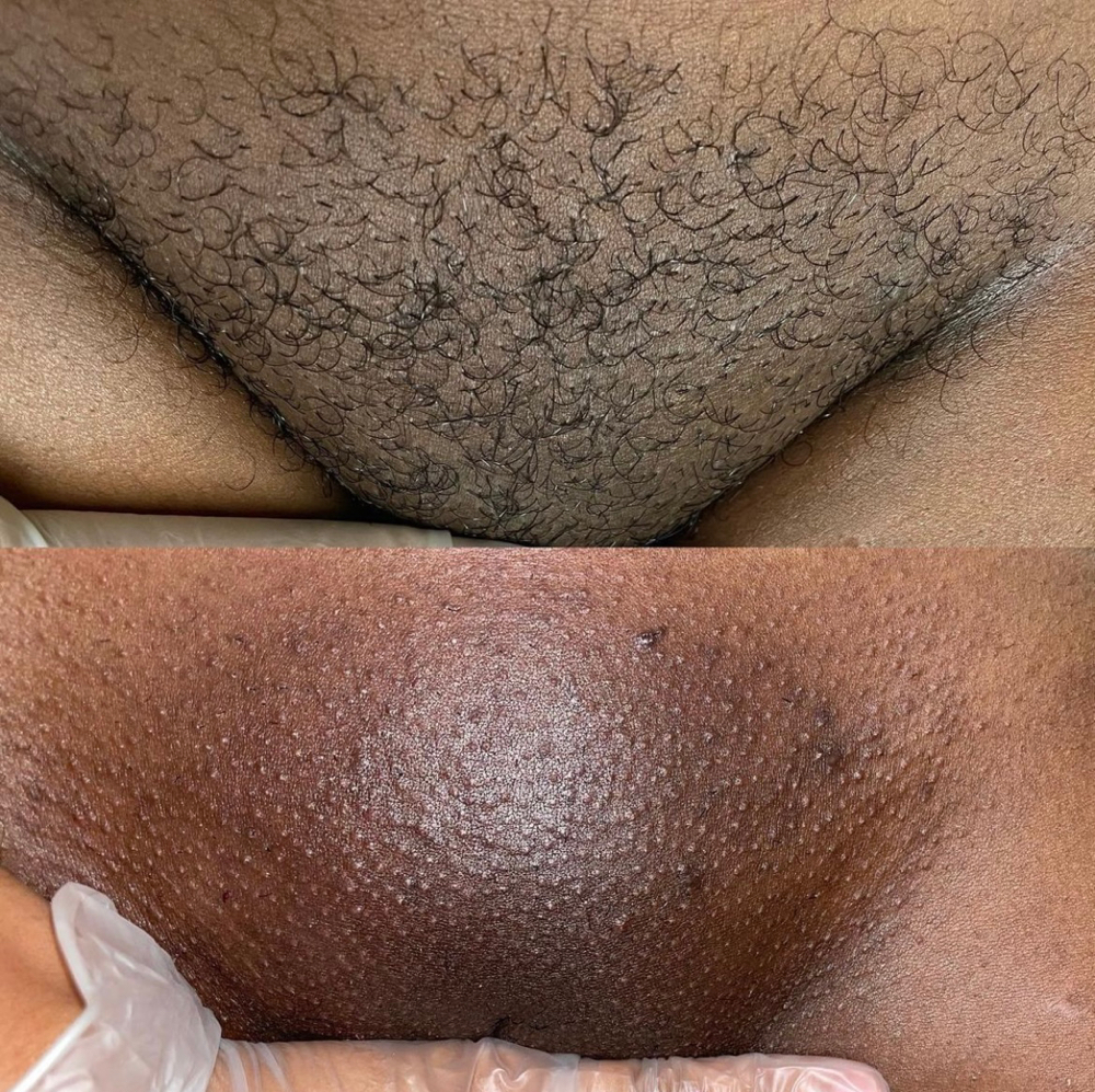 Brazilian Wax