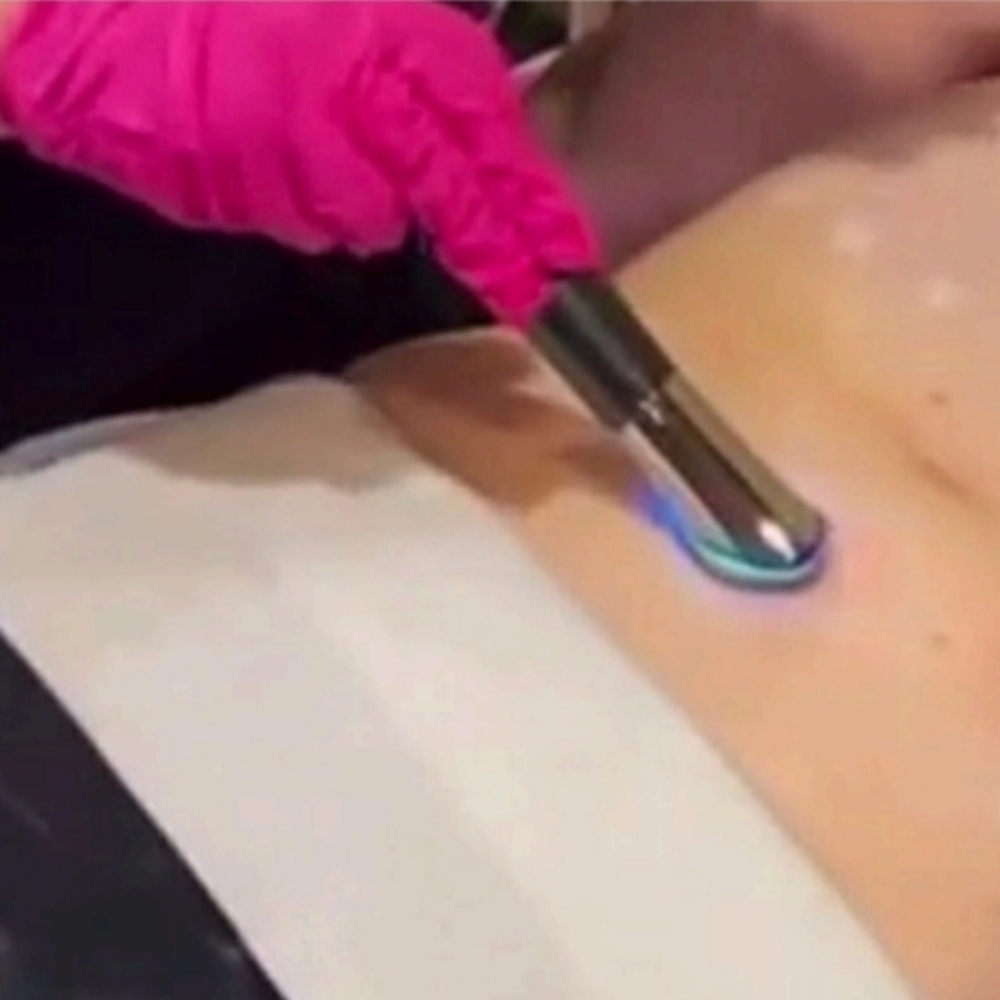 Virtual Mesotherapy (Stomach or Back) at Le Bar Beaute in Indian Trail, NC
