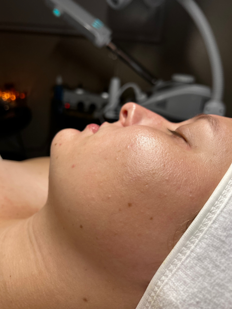 Dermaplane Facial