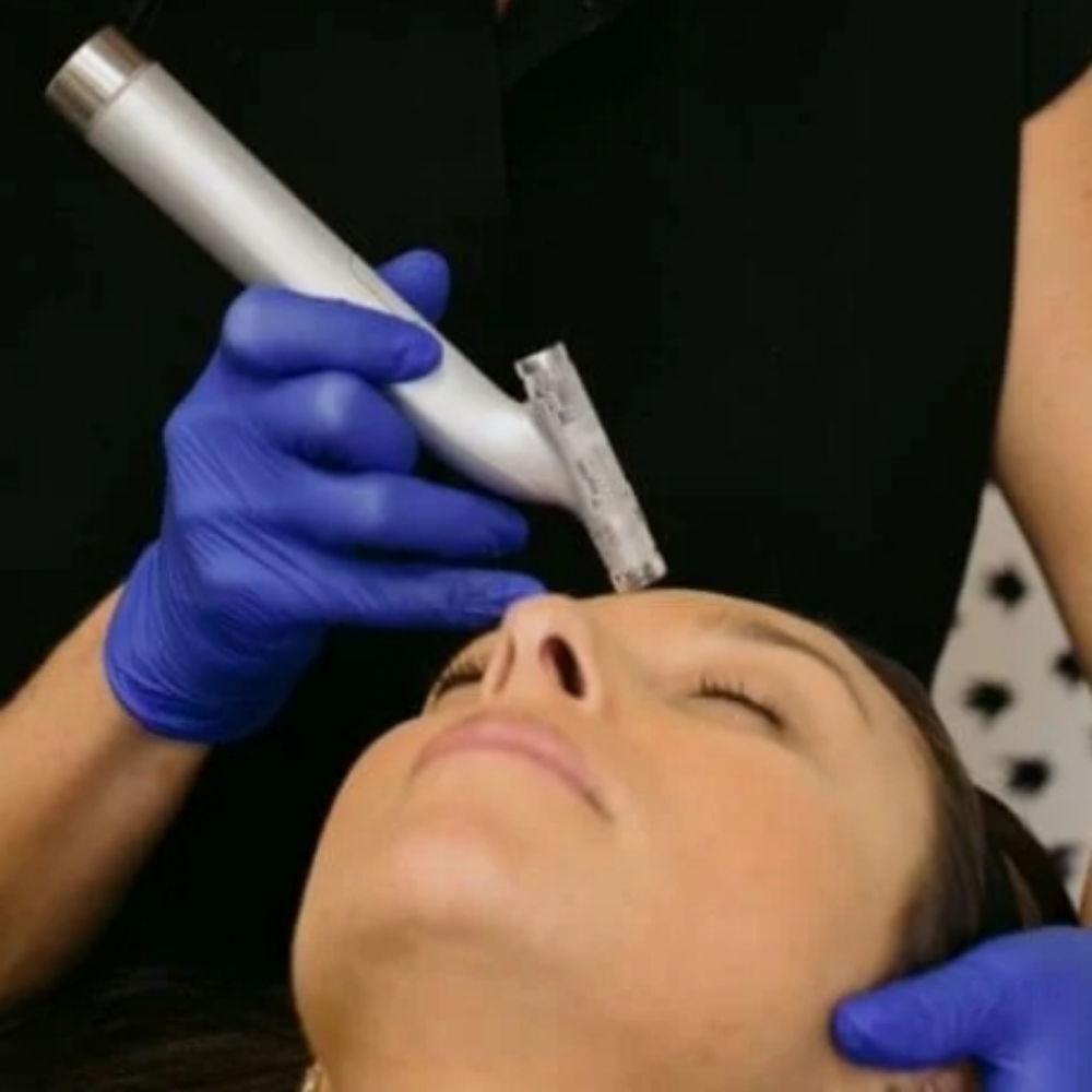 Premium Microneedling- Face at Aesthetics by Malory in Lubbock, TX