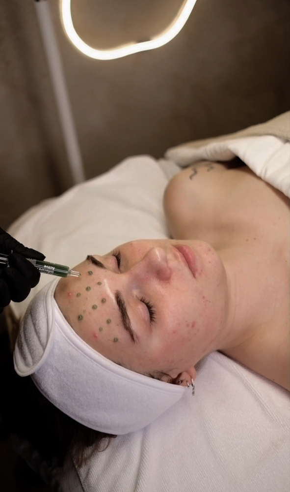 The Acne Peel