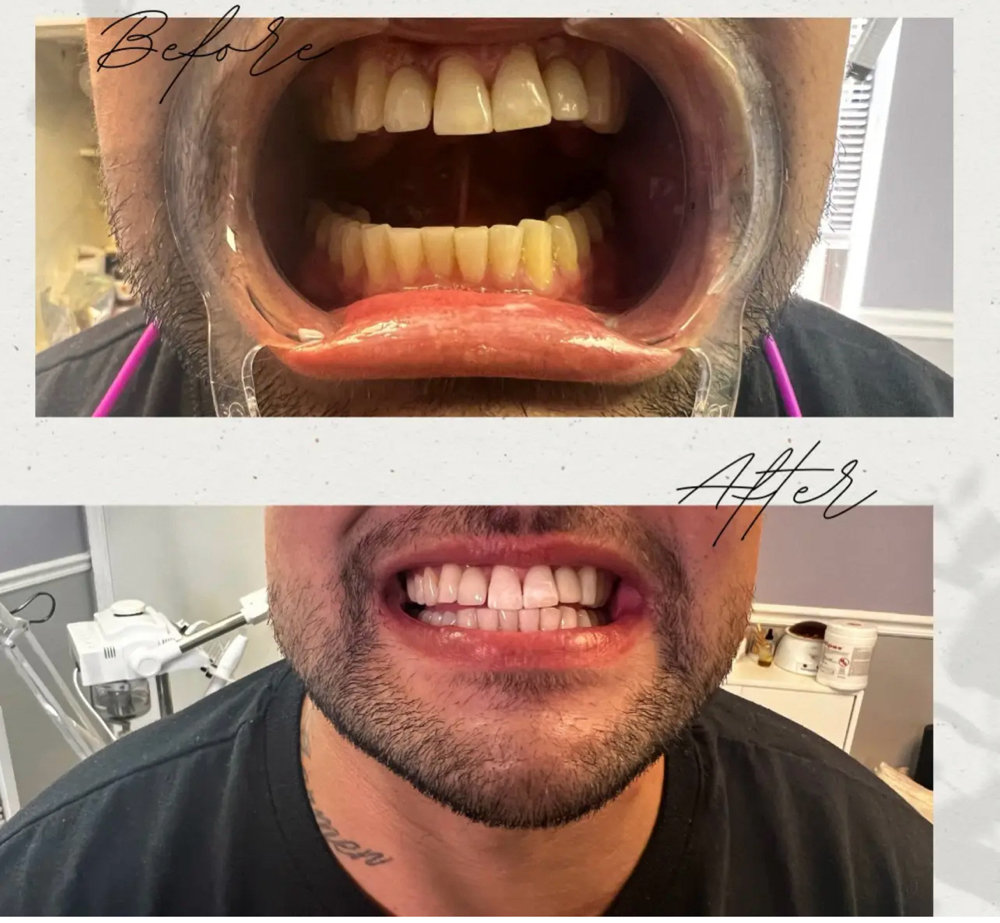 60 min Teeth Whitening