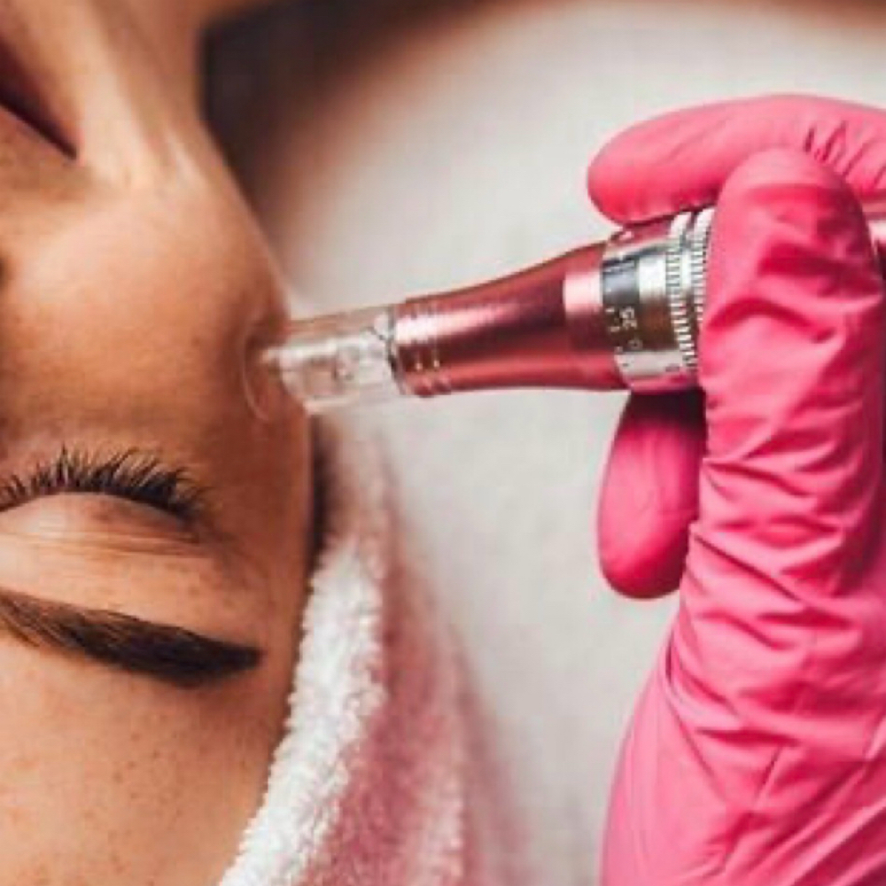 Microneedling Treatment at The Beauty Lab in Williamsville, NY