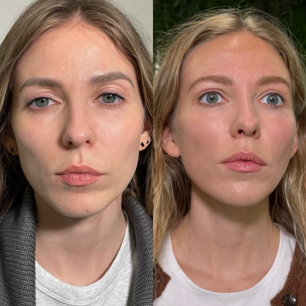 Permanent Removing at Violetta Stankevich in Charlotte, NC