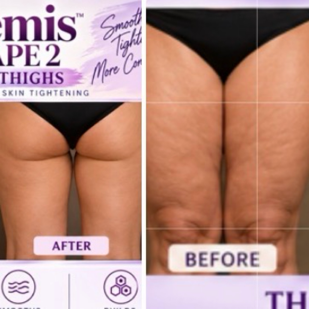 Artemis T- Shape 2 - Front + Back of Thighs at Mirrored Image Beauty & Wellness in Oconomowoc, WI