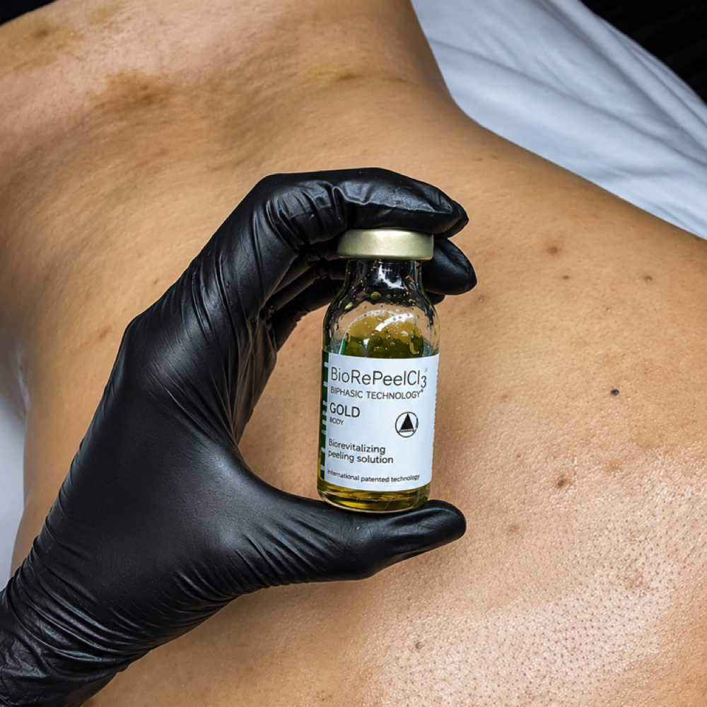 Biorepeel gold Body Chemical Peel at Esther Esthetics in Suwanee, GA