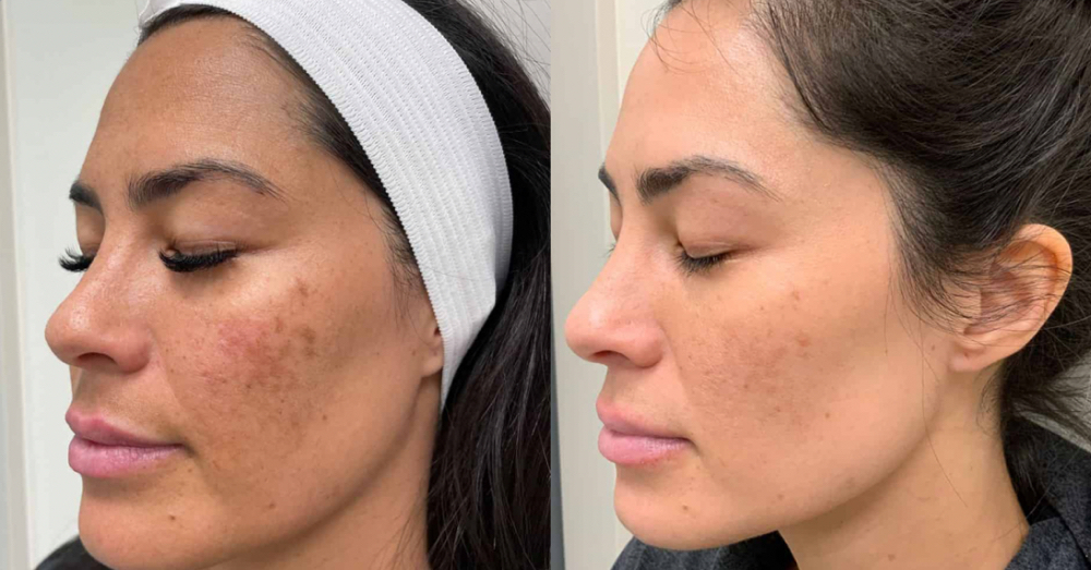 Bio-Treatment Facial