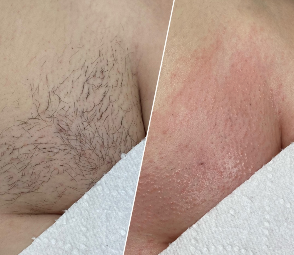 Brazilian Waxing